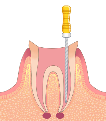 根管治療