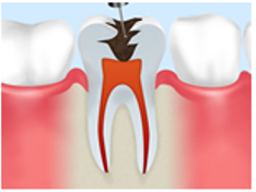 重度のむし歯に実施