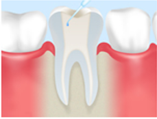 根管を殺菌